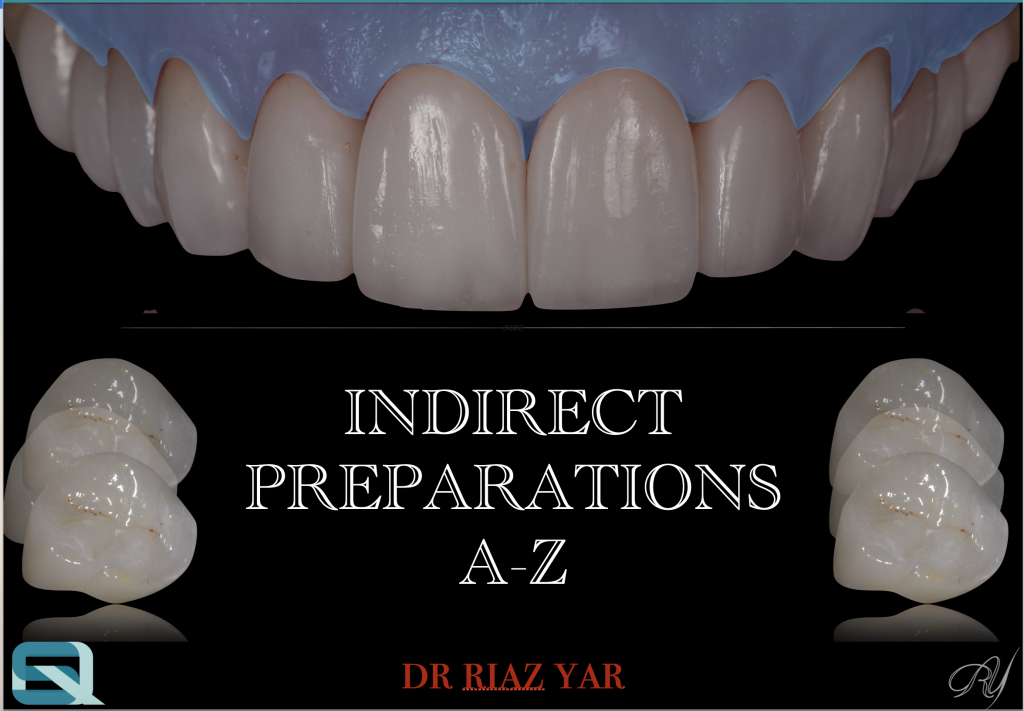 Indirect Restoration Slot Or Not The Square Dental